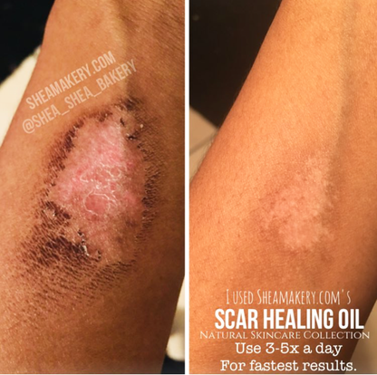 Scars/Stretch Marks/Uneven Tone Healing Serum
